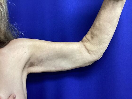 Arm Contouring / Lift: Case 10 (2905830) - Left front, after