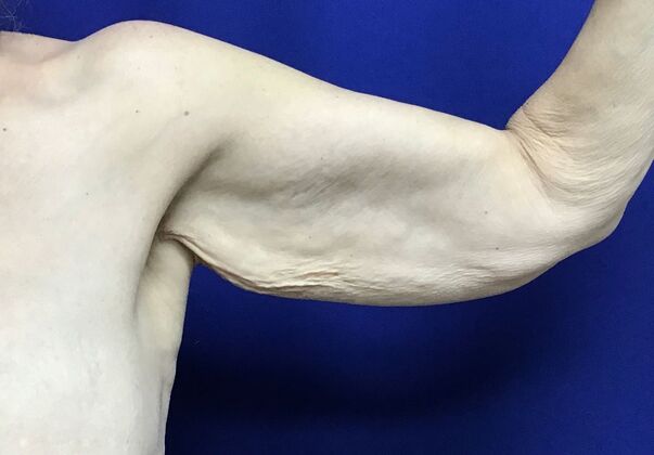 Arm Contouring / Lift: Case 10 (2905830) - Left front, before