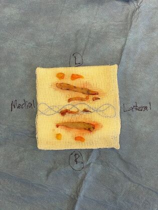 Facial Eyelid Surgery / Blepharoplasty: Case 17 (34782) - Surgical specimen showing fat pockets and skin removed