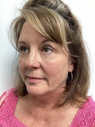 Facial Eyelid Surgery / Blepharoplasty: Case 17 (34782) - After