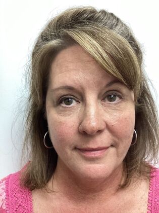 Facial Eyelid Surgery / Blepharoplasty: Case 17 (34782) - After