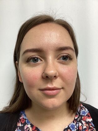 Chin / Neck Liposustion: Case 2 (34710) - Before