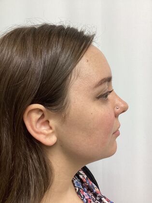 Chin / Neck Liposustion Case 2 (34710) - Before