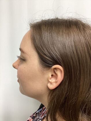 Chin / Neck Liposustion: Case 2 (34710) - Before