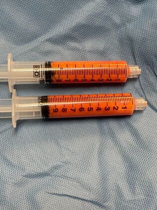 Chin / Neck Liposustion: Case 2 (34710) - Before