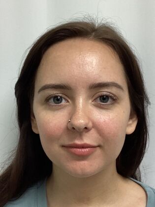 Chin / Neck Liposustion: Case 2 (34710) - After