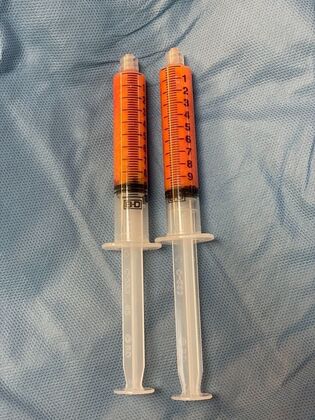 Chin / Neck Liposustion: Case 2 (34710) - After