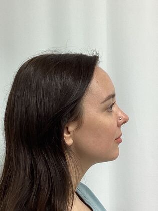 Chin / Neck Liposustion Case 2 (34710) - After