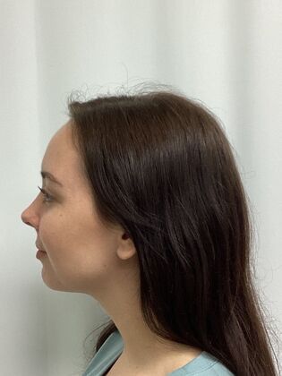 Chin / Neck Liposustion: Case 2 (34710) - After