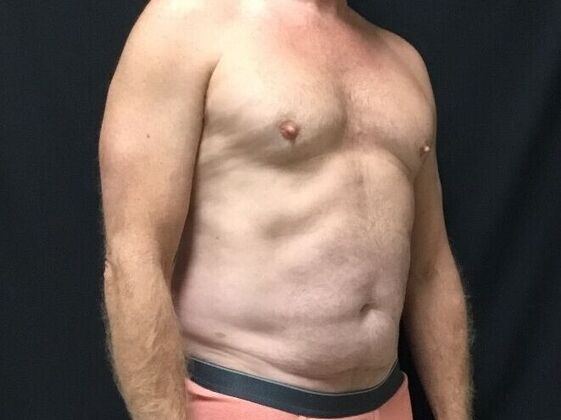 Morpheus 8: Case 5 - After