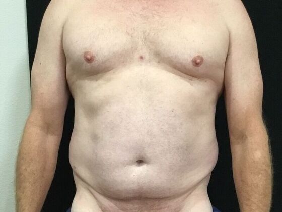 Morpheus 8 Case 5 - Before