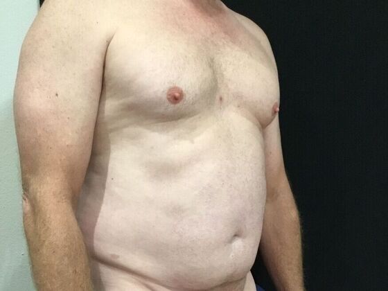 Morpheus 8: Case 5 - Before