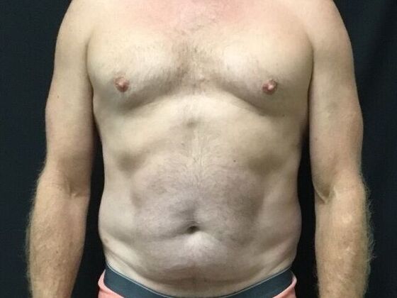 Morpheus 8 Case 5 - After