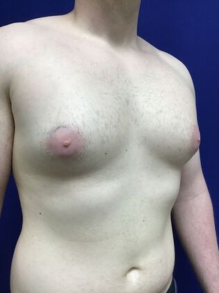 Male Breast / Gynecomastia: Case 10 (33852) - Before