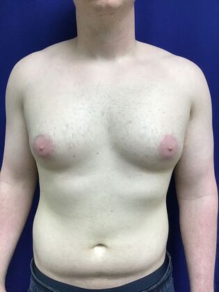 Male Breast / Gynecomastia: Case 10 (33852) - Before