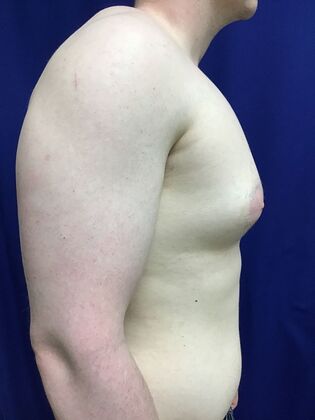 Male Breast / Gynecomastia: Case 10 (33852) - Before