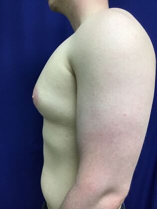 Male Breast / Gynecomastia: Case 10 (33852) - Before