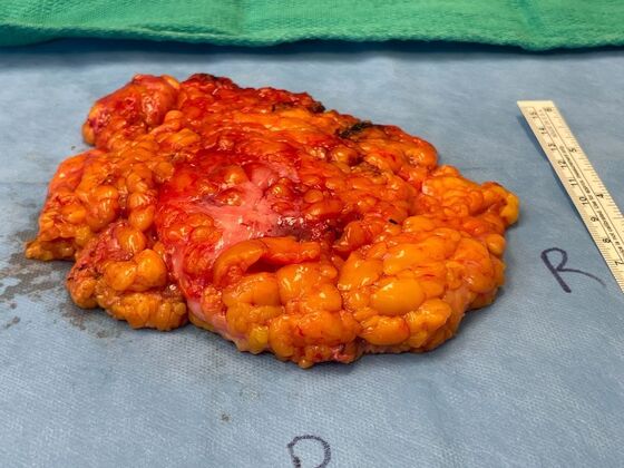 Male Breast / Gynecomastia: Case 10 (33852) - tissue removed, R