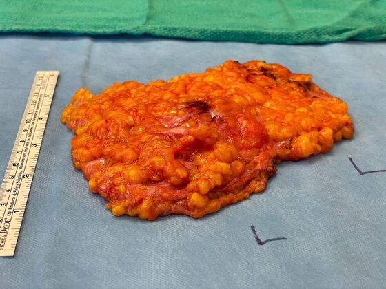 Male Breast / Gynecomastia: Case 10 (33852) - tissue removed, L