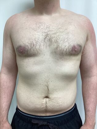 Male Breast / Gynecomastia: Case 10 (33852) - After, areola shrinks