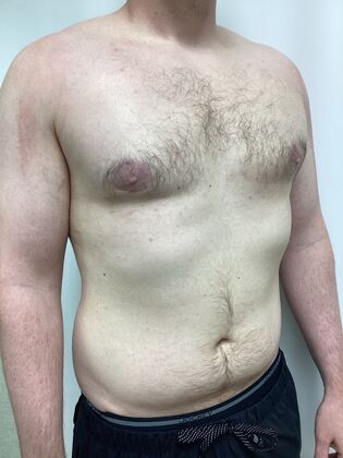 Male Breast / Gynecomastia: Case 10 (33852) - After, muscle development in now obvious