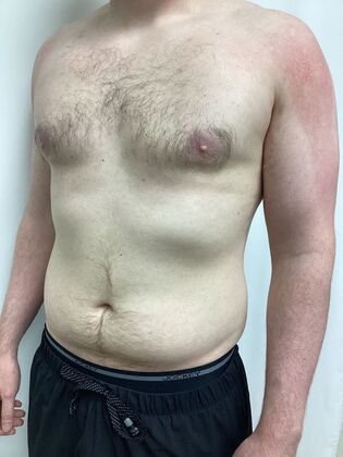 Male Breast / Gynecomastia: Case 10 (33852) - After