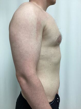 Male Breast / Gynecomastia: Case 10 (33852) - After