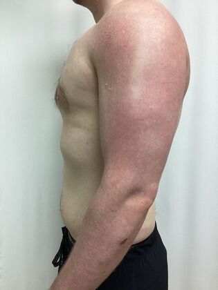 Male Breast / Gynecomastia: Case 10 (33852) - After