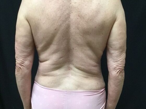 Morpheus 8 Case 6 - After