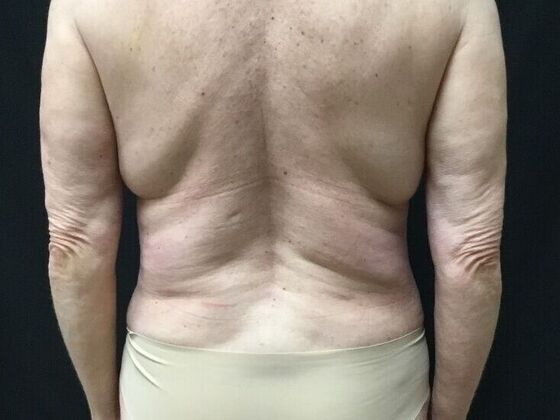 Morpheus 8 Case 6 - Before