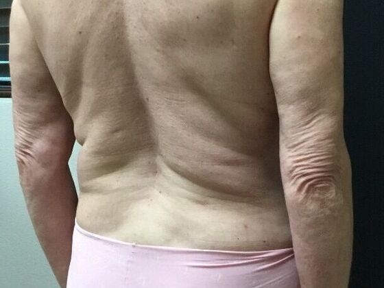 Morpheus 8: Case 6 - After