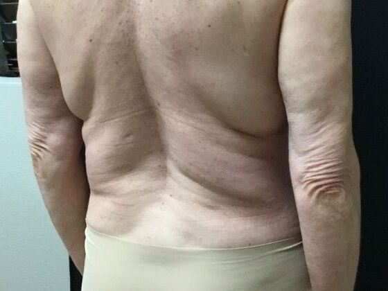 Morpheus 8: Case 6 - Before