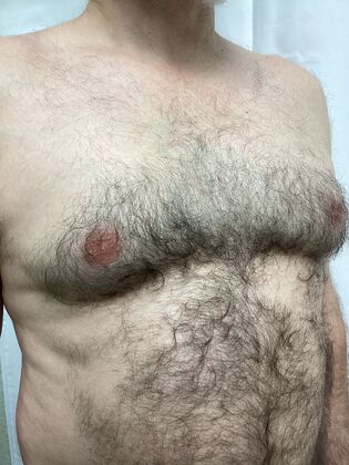 Male Breast / Gynecomastia: Case 11 (34524) - Before