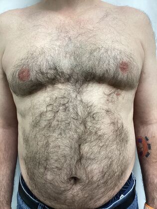 Male Breast / Gynecomastia: Case 11 (34524) - Before
