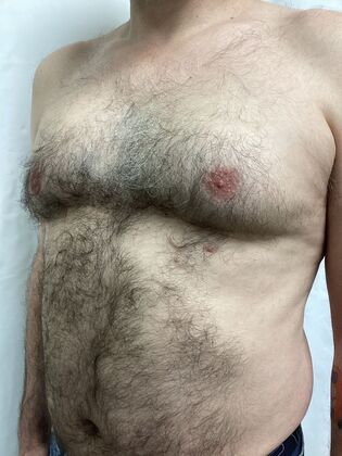 Male Breast / Gynecomastia: Case 11 (34524) - Before