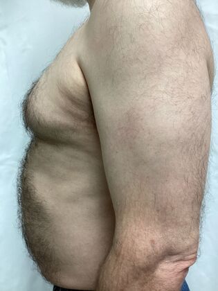 Male Breast / Gynecomastia: Case 11 (34524) - Before