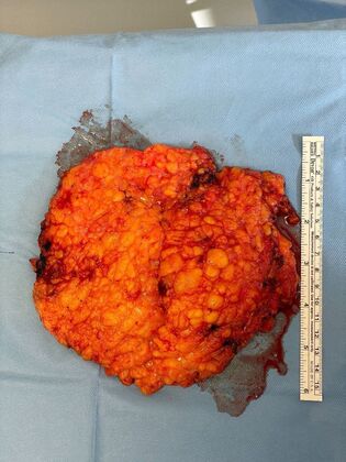 Male Breast / Gynecomastia: Case 11 (34524) - Specimen #2
