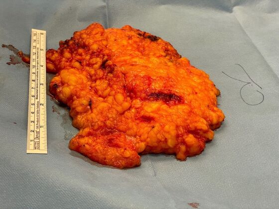 Male Breast / Gynecomastia: Case 11 (34524) - Specimen #1 removed