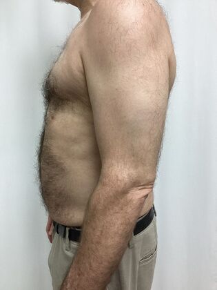 Male Breast / Gynecomastia: Case 11 (34524) - After