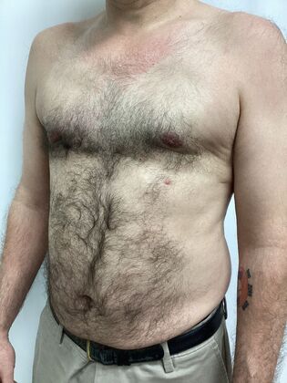 Male Breast / Gynecomastia: Case 11 (34524) - After