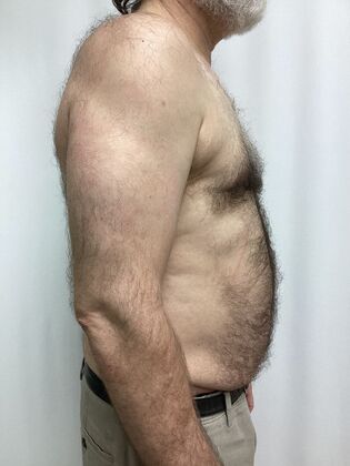Male Breast / Gynecomastia: Case 11 (34524) - After