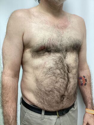 Male Breast / Gynecomastia: Case 11 (34524) - After
