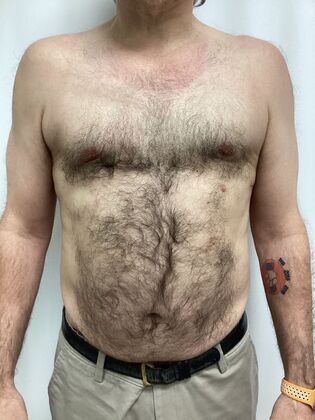 Male Breast / Gynecomastia: Case 11 (34524) - After