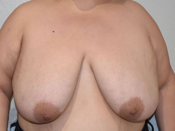 Breast Reduction Case 202 - Before