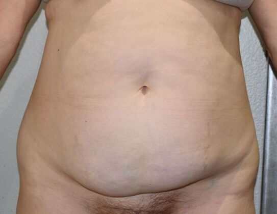 Tummy Tuck (Abdominoplasty) Case 538 - Before