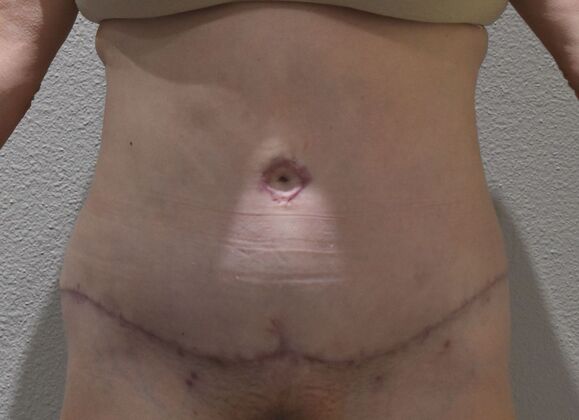Tummy Tuck (Abdominoplasty) Case 538 - After