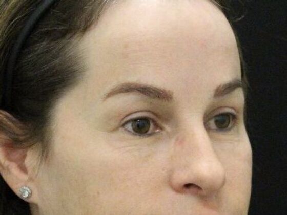 Forehead & Brow Lifts: Case 8 - After