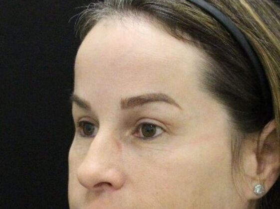 Forehead & Brow Lifts: Case 8 - After