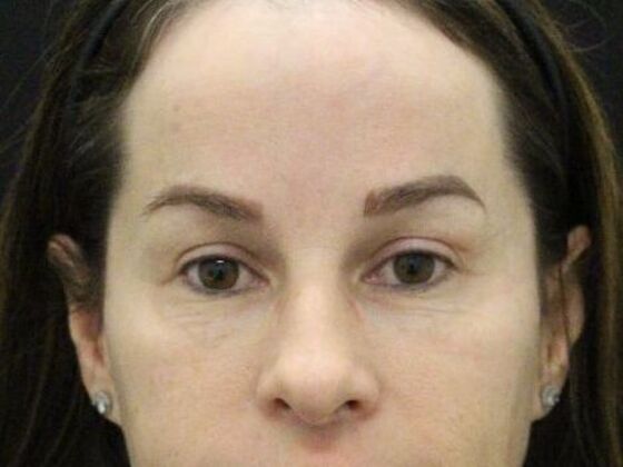 Forehead & Brow Lifts Case 8 - After