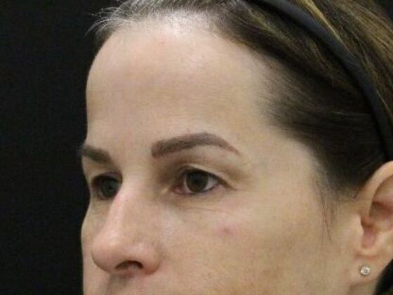 Forehead & Brow Lifts: Case 8 - Before